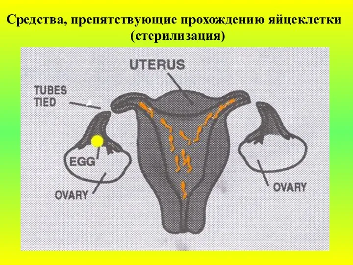 Средства, препятствующие прохождению яйцеклетки (стерилизация)