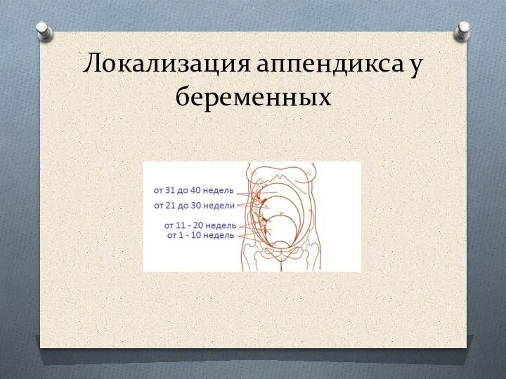 Локализация аппендикса у беременных