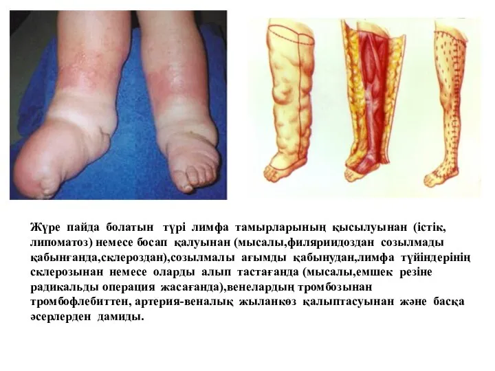 Жүре пайда болатын түрі лимфа тамырларының қысылуынан (істік,липоматоз) немесе босап қалуынан (мысалы,филяриидоздан