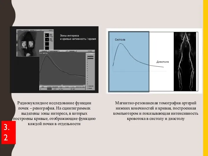 Радионуклидное исследование функции почек – ренография. На сцинтиграммах выделены зоны интереса, в