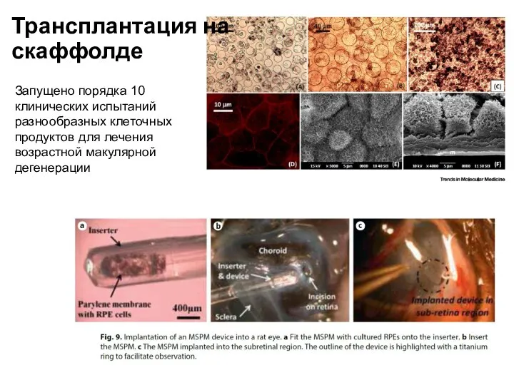 Трансплантация на скаффолде Запущено порядка 10 клинических испытаний разнообразных клеточных продуктов для лечения возрастной макулярной дегенерации