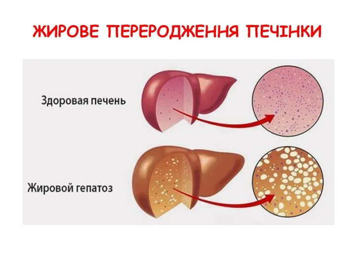 ЖИРОВЕ ПЕРЕРОДЖЕННЯ ПЕЧІНКИ