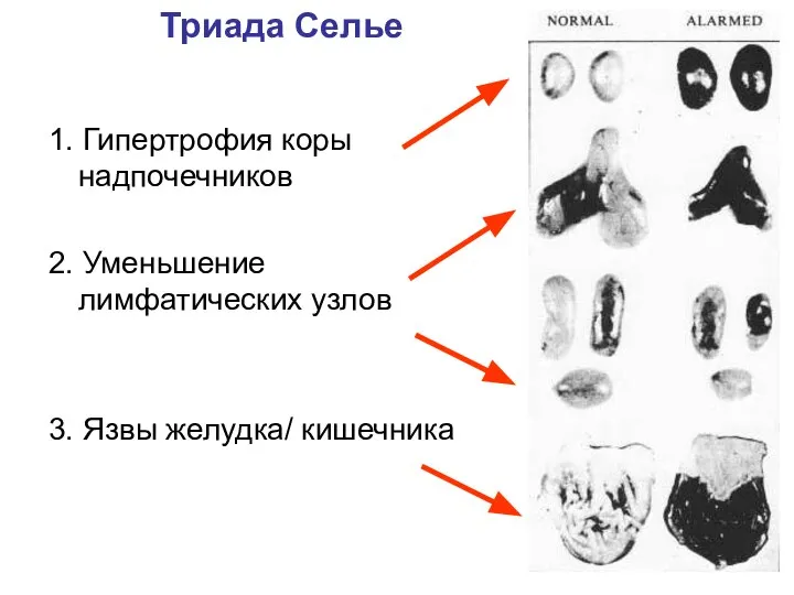 Триада Селье 1. Гипертрофия коры надпочечников 2. Уменьшение лимфатических узлов 3. Язвы желудка/ кишечника