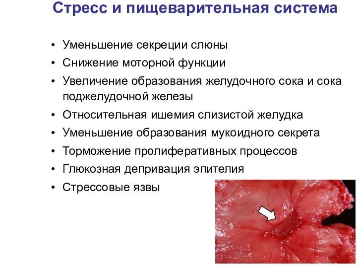 Стресс и пищеварительная система Уменьшение секреции слюны Снижение моторной функции Увеличение образования