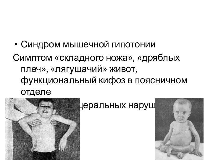 Синдром мышечной гипотонии Симптом «складного ножа», «дряблых плеч», «лягушачий» живот, функциональный кифоз