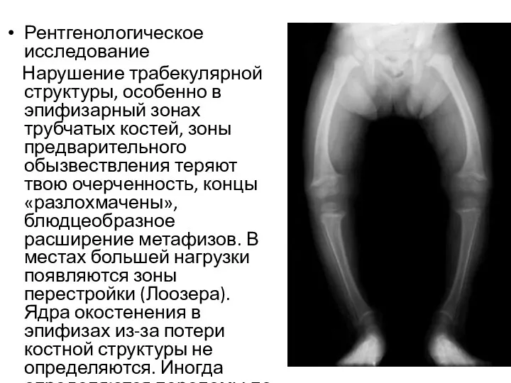 Рентгенологическое исследование Нарушение трабекулярной структуры, особенно в эпифизарный зонах трубчатых костей, зоны