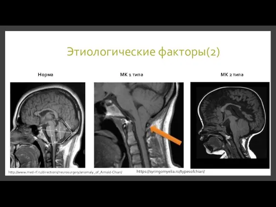 Норма МК 1 типа МК 2 типа Этиологические факторы(2) https://syringomyelia.ru/typesofchiari/ http://www.med-rf.ru/directions/neurosurgery/anomaly_of_Arnold-Chiari/