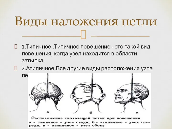 1.Типичное .Типичное повешение - это такой вид повешения, когда узел находится в