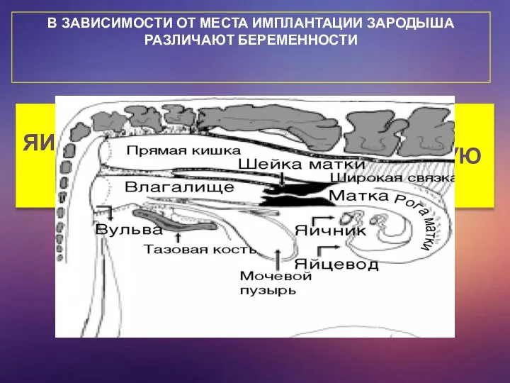 В ЗАВИСИМОСТИ ОТ МЕСТА ИМПЛАНТАЦИИ ЗАРОДЫША РАЗЛИЧАЮТ БЕРЕМЕННОСТИ ЯИЧНИКОВУЮ ТРУБНУЮ БРЮШНУЮ