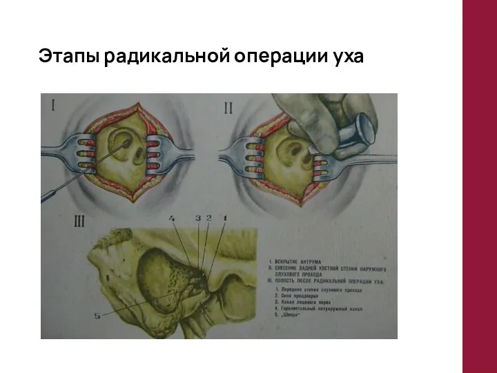 Этапы радикальной операции уха