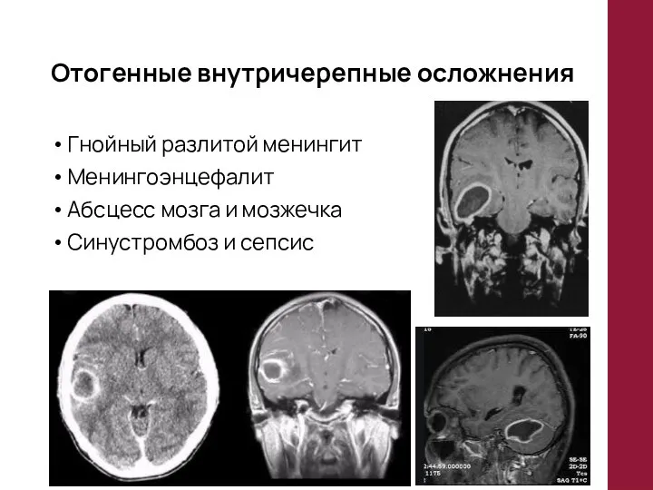 Отогенные внутричерепные осложнения Гнойный разлитой менингит Менингоэнцефалит Абсцесс мозга и мозжечка Синустромбоз и сепсис