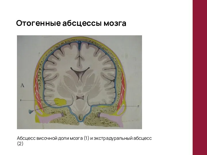 Отогенные абсцессы мозга Абсцесс височной доли мозга (1) и экстрадуральный абсцесс (2)