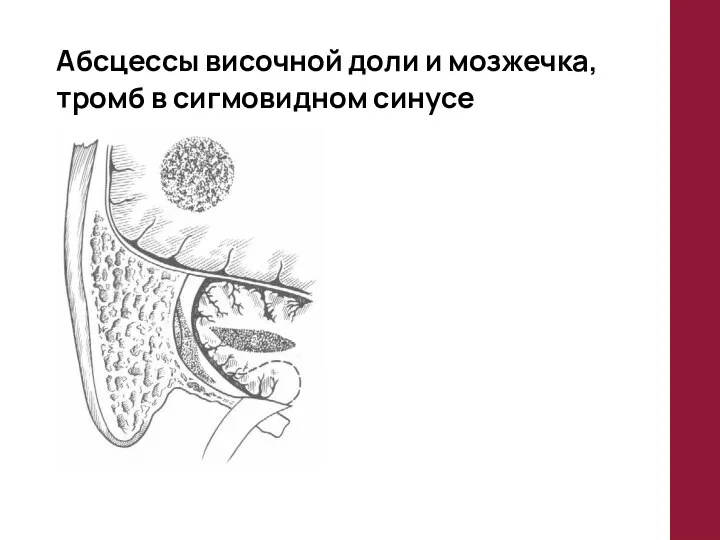 Абсцессы височной доли и мозжечка, тромб в сигмовидном синусе