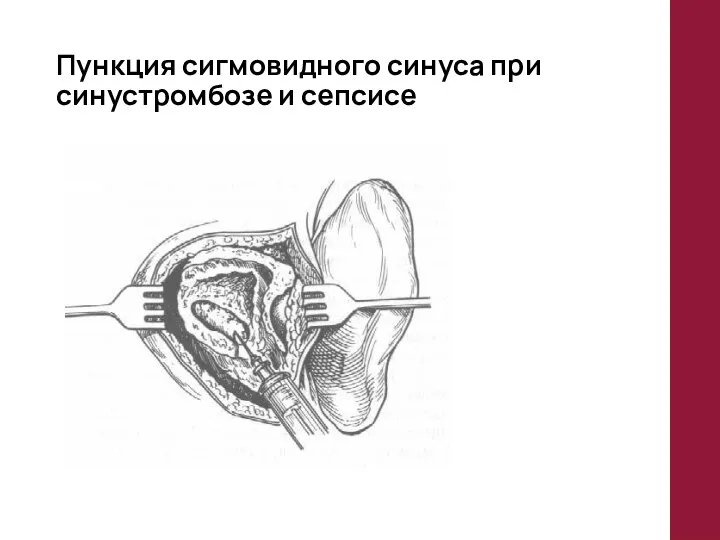 Пункция сигмовидного синуса при синустромбозе и сепсисе