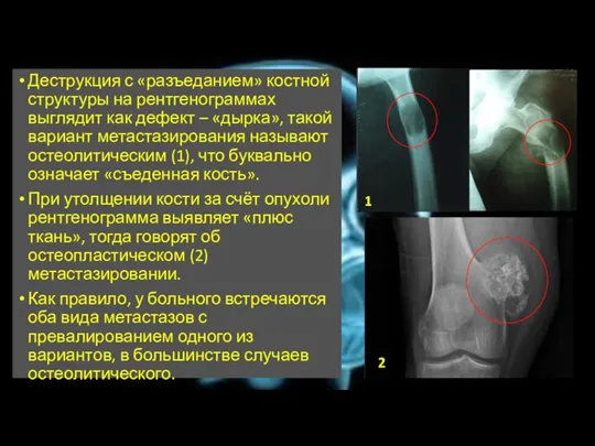 Деструкция с «разъеданием» костной структуры на рентгенограммах выглядит как дефект – «дырка»,