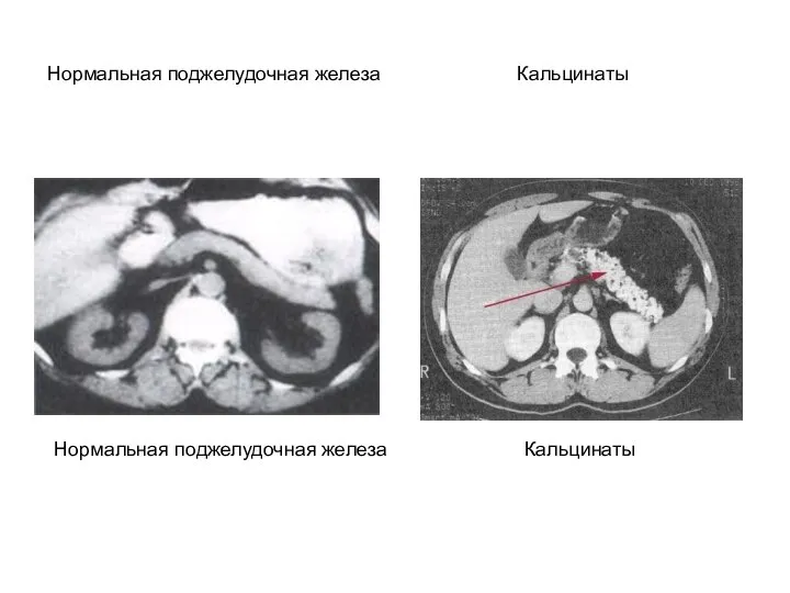 Нормальная поджелудочная железа Кальцинаты Нормальная поджелудочная железа Кальцинаты