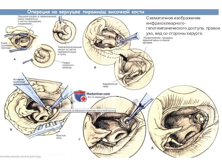 Схематичное изображение инфракохлеарного-гипотимпанического доступа, правое ухо, вид со стороны хирурга.
