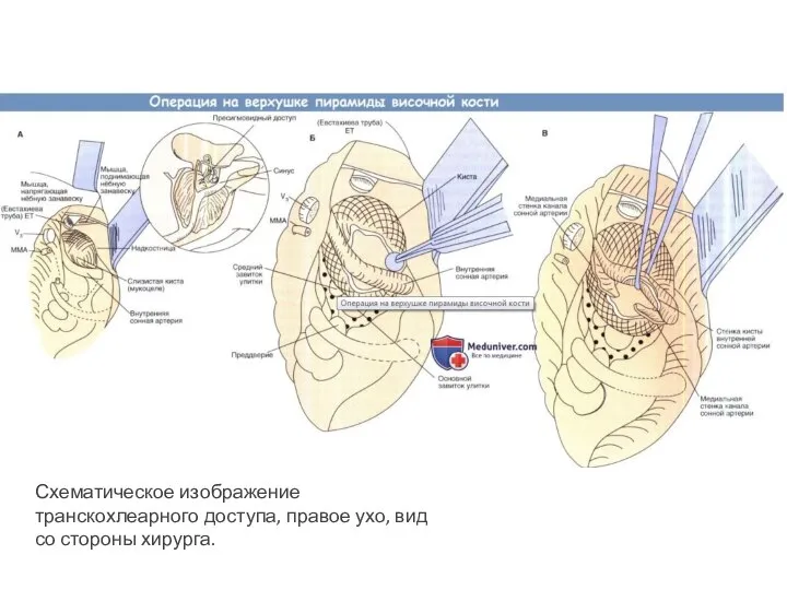 Схематическое изображение транскохлеарного доступа, правое ухо, вид со стороны хирурга.