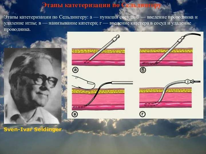 Этапы катетеризации по Сельдингеру Этапы катетеризации по Сельдингеру: а — пункция сосуда;