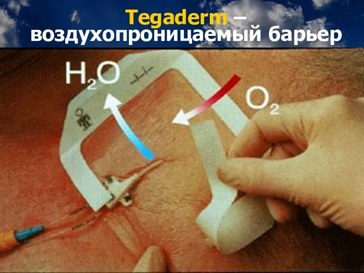 Tegaderm – воздухопроницаемый барьер