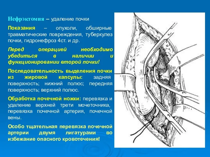 Нефрэктомия – удаление почки Показания – опухоли, обширные травматические повреждения, туберкулез почки,