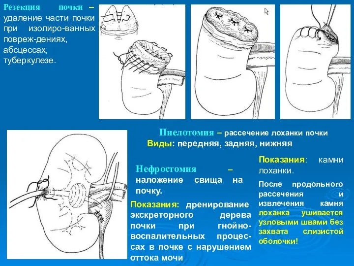 Резекция почки – удаление части почки при изолиро-ванных повреж-дениях, абсцессах, туберкулезе. Пиелотомия