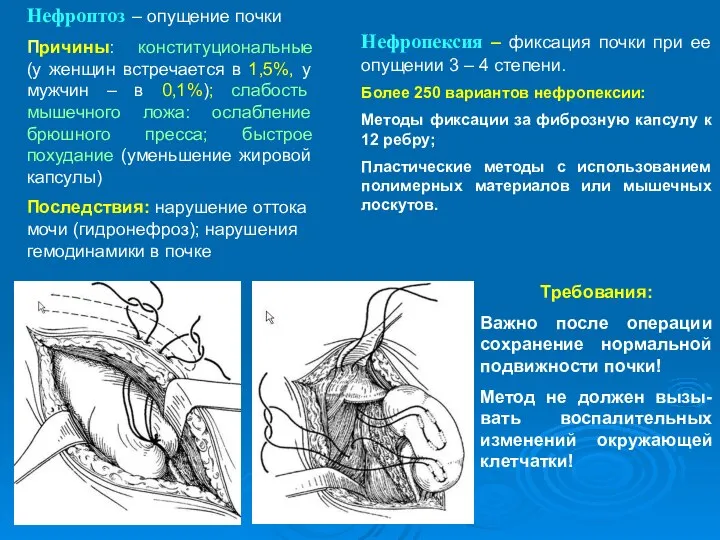 Нефропексия – фиксация почки при ее опущении 3 – 4 степени. Более