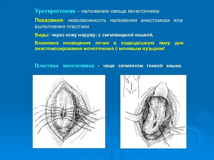 Уретеростомия – наложение свища мочеточника. Показания: невозможность наложения анастомоза или выполнения пластики