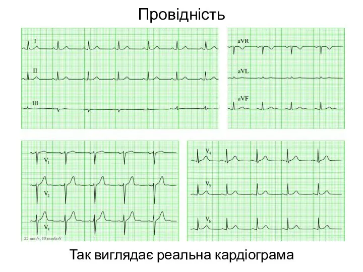 Провідність Так виглядає реальна кардіограма