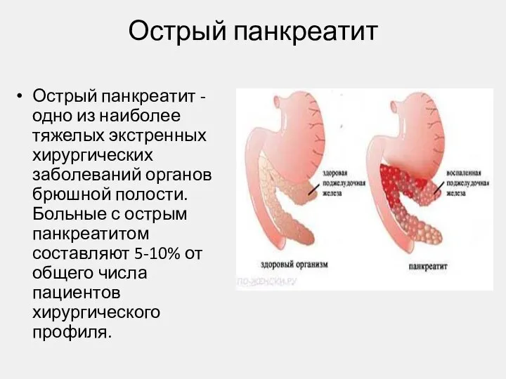 Острый панкреатит Острый панкреатит - одно из наиболее тяжелых экстренных хирургических заболеваний