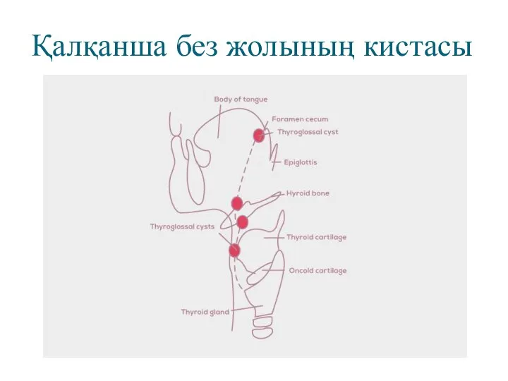 Қалқанша без жолының кистасы