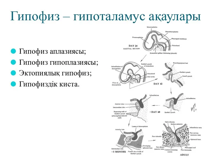 Гипофиз аплазиясы; Гипофиз гипоплазиясы; Эктопиялық гипофиз; Гипофиздік киста. Гипофиз – гипоталамус ақаулары