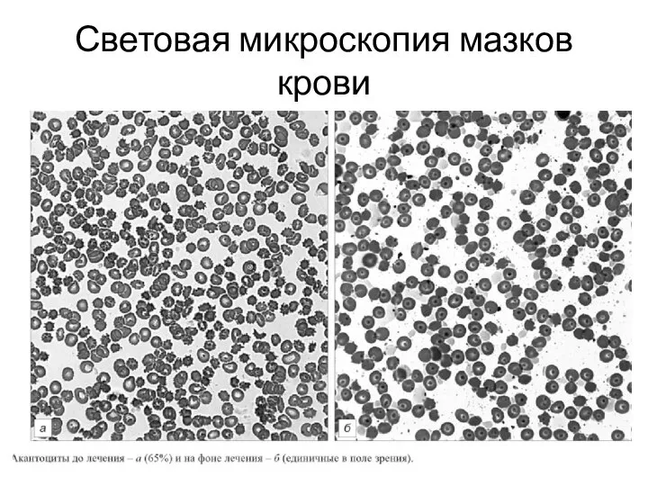 Световая микроскопия мазков крови