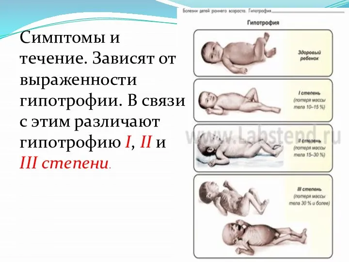 Симптомы и течение. Зависят от выраженности гипотрофии. В связи с этим различают