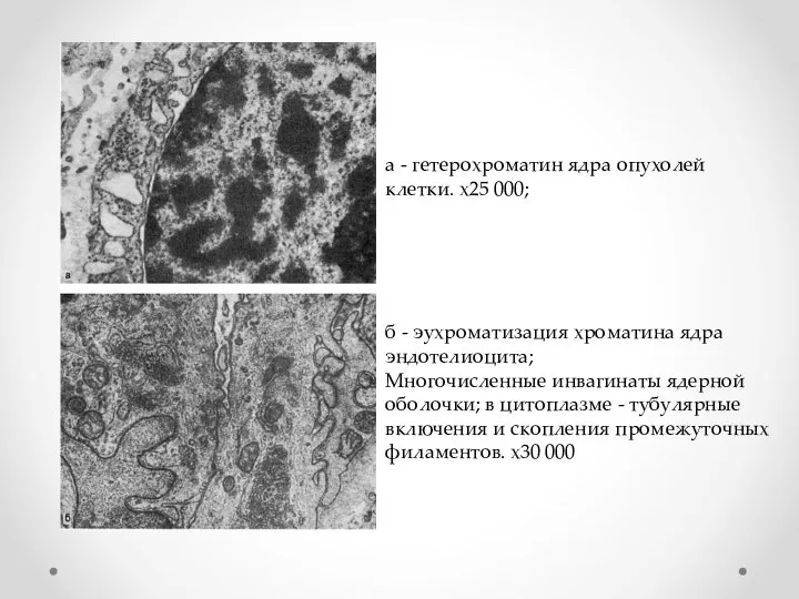 а - гетерохроматин ядра опухолей клетки. х25 000; б - эухроматизация хроматина