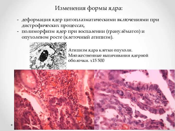 Изменения формы ядра: деформация ядер цитоплазматическими включениями при дистрофических процессах, полиморфизм ядер