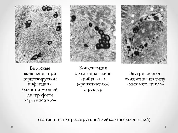 (пациент с прогрессирующей лейкоэнцефалопатией) Вирусные включения при герпесвирусной инфекции с баллонирующей дистрофией