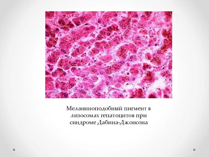 Меланиноподобный пигмент в лизосомах гепатоцитов при синдроме Дабина-Джонсона