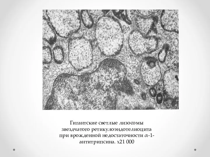 Гигантские светлые лизосомы звездчатого ретикулоэндотелиоцита при врожденной недостаточности α-1-антитрипсина. х21 000
