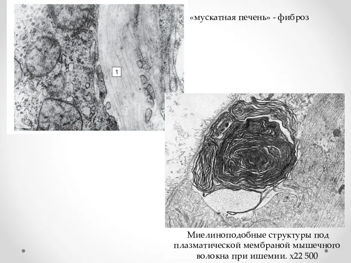 «мускатная печень» - фиброз Миелиноподобные структуры под плазматической мембраной мышечного волокна при ишемии. х22 500