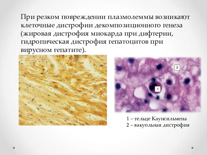 При резком повреждении плазмолеммы возникают клеточные дистрофии декомпозиционного генеза (жировая дистрофия миокарда