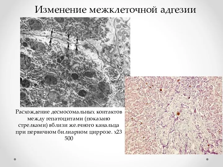 Расхождение десмосомальных контактов между гепатоцитами (показано стрелками) вблизи желчного канальца при первичном