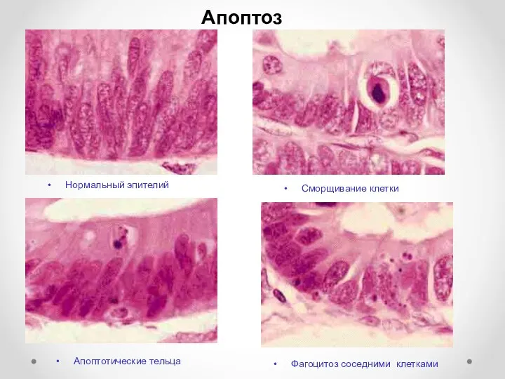 Апоптоз Нормальный эпителий Сморщивание клетки Апоптотические тельца Фагоцитоз соседними клетками