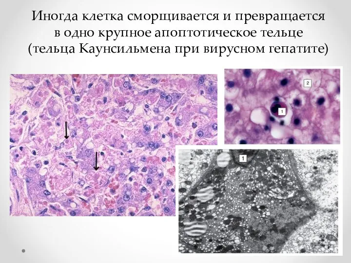 Иногда клетка сморщивается и превращается в одно крупное апоптотическое тельце (тельца Каунсильмена при вирусном гепатите)