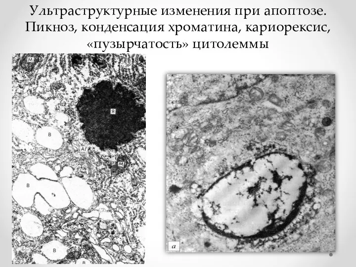 Ультраструктурные изменения при апоптозе. Пикноз, конденсация хроматина, кариорексис, «пузырчатость» цитолеммы