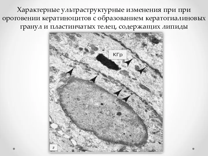 Характерные ультраструктурные изменения при при ороговении кератиноцитов с образованием кератогиалиновых гранул и пластинчатых телец, содержащих липиды