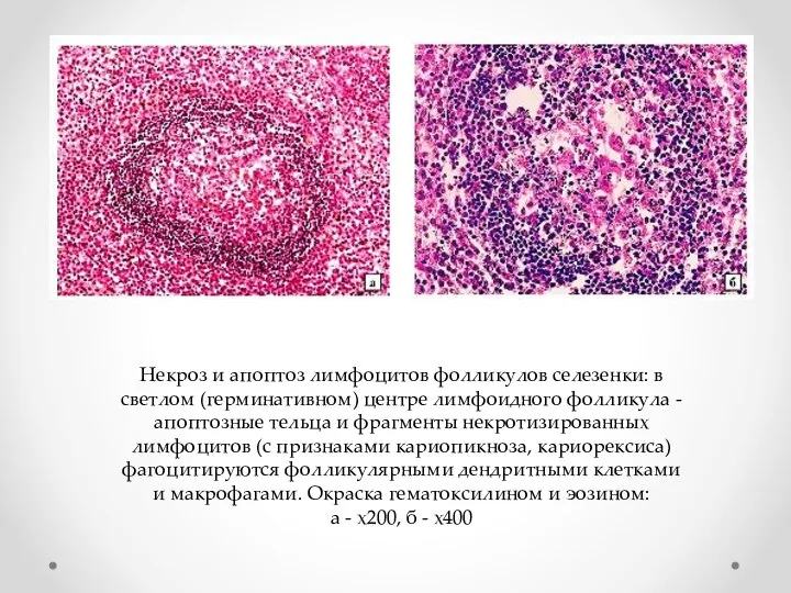 Некроз и апоптоз лимфоцитов фолликулов селезенки: в светлом (герминативном) центре лимфоидного фолликула