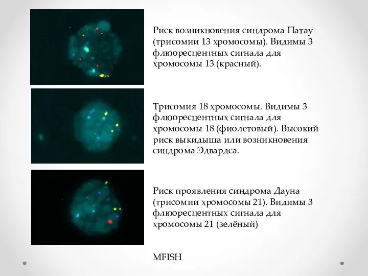 Трисомия 18 хромосомы. Видимы 3 флюоресцентных сигнала для хромосомы 18 (фиолетовый). Высокий