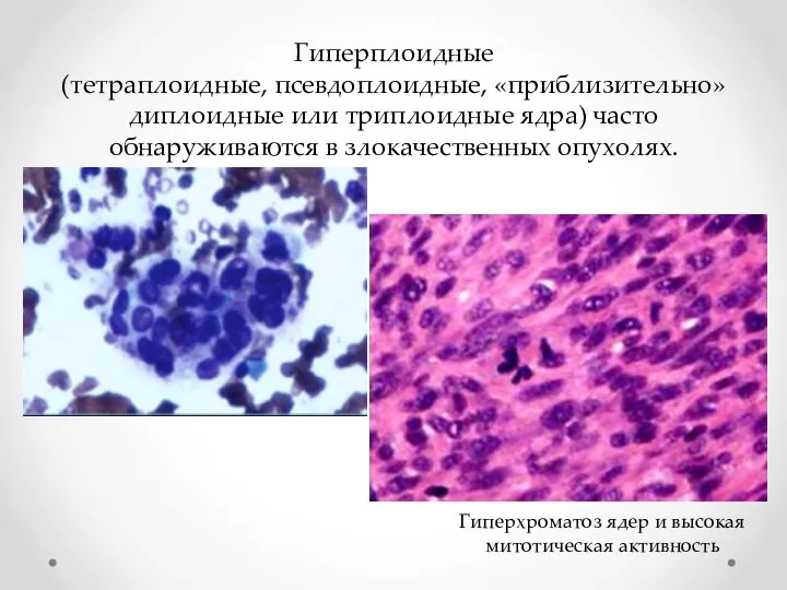 Гиперплоидные (тетраплоидные, псевдоплоидные, «приблизительно» диплоидные или триплоидные ядра) часто обнаруживаются в злокачественных