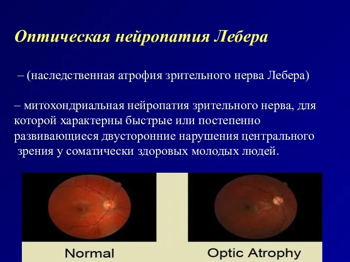 Оптическая нейропатия Лебера – (наследственная атрофия зрительного нерва Лебера) – митохондриальная нейропатия